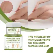 Varicose Veins Cream